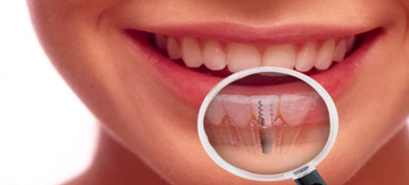 Οδοντικά Εμφυτεύματα