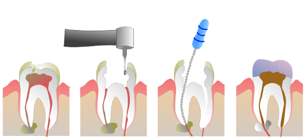 Ενδοδοντία